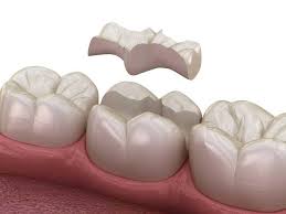 In der zahnmedizin wird die entfernung eines zahnes, ohne dass eine operation notwendig ist, auch extraktion bezeichnet. Teilkronen Sind Eine Variante Der Zahnkronen Wo Ist Der Unterschied