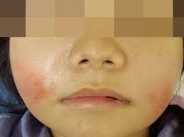 Tại sao cấy mỡ mặt bị vón cục? Giải pháp là gì?