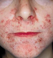Image result for red rash face