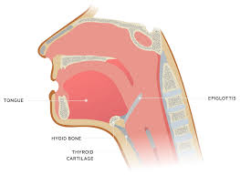 Image result for Epiglottitis