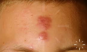 Image result for zoster under breasts