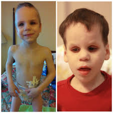 Mother of mono-di twin girls shares experience