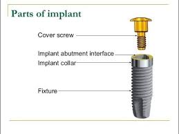 Parts Of Dental Implant Youtube