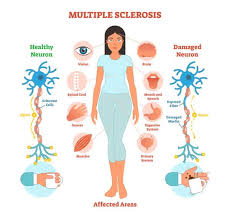 Ask 10 people with multiple sclerosis (ms) what their symptoms are, and you'll likely get 10 different answers. Bodywork For Ms Patients Massage Professional News
