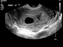 Tamil language is one of the famous and ancient dravidian languages spoken by people in tamil nadu and the 5th most spoken language in india. Pregnancy Of Uncertain Viability Radiology Reference Article Radiopaedia Org