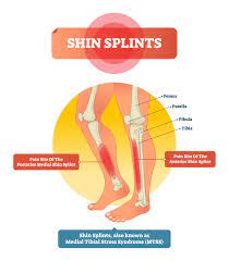 What Are Shin Splints? | Orthopaedic Associates Of St. Augustine