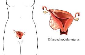 Endometrial cancer is sometimes called uterine cancer. Endometrial Cancer Uva Health Charlottesville