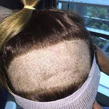 Oggi, il trapianto di capelli si può fare senza rasarsi che noi chiamiamo fue senza la . Trapianto Capelli Senza Rasatura Without Shave Technique Prime Htc