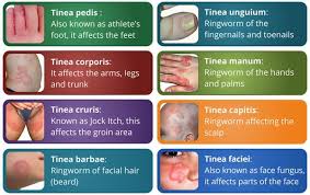 A Blog About Homeopathy Skin Hair And Beauty Use Of Homeopathy In Various Condition Plaque Psoriasis Treatment Homeopathy Fungal Infection Skin