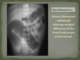 Hirschsprung Disease