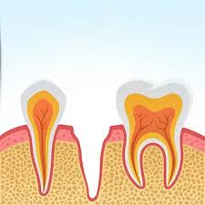 Image result for Dry Socket