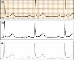 A Sample Ecg Paper Image B Result Of The Thresholding
