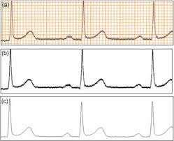 a sample ecg paper image b result of the thresholding