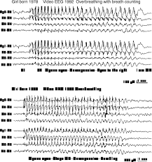 Image result for Absence Seizure