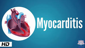 The duration of problems can vary from hours to months. Myocarditis Causes Signs And Symptoms Diagnosis Treatment Youtube