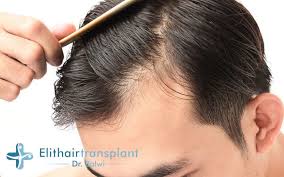 Haarausfall Am Haaransatz Haare Pflegen Haarkuren Haarausfall