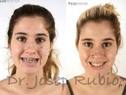 Compartimos el caso de María tratada mediante cirugía ortognática bimaxilar  para corregir una deformidad dentofacial clase III esquelética por  hipoplasia maxilar y asimetría mandibular. 📝 El plan de tratamiento fue: