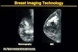 (info on mammograms from american cancer society at mammogram basics | how does a have you been spooked by newspaper (tabloids?) report like the daily mail regular mammograms raise the risk of cancer? Mammogram Images Normal And Abnormal