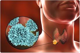 · a lump , swelling in the neck, early thyroid cancers are found when patients see their doctors because of neck nodules they notice. What Is Thyroid Cancer