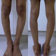 Image result for Genu Varum