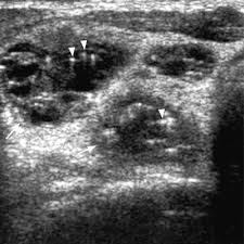Fna might also be used in patients whose cancer has been treated by surgery and/or radiation therapy , to help find out if a neck mass in the treated area is scar tissue or if it's a return (recurrence) of the cancer. Ultrasound Investigations In Head And Neck Cancer Patients Springerlink