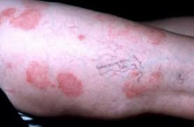 Viral hepatitis was excluded by serological tests. Nummulares Ekzem Deximed