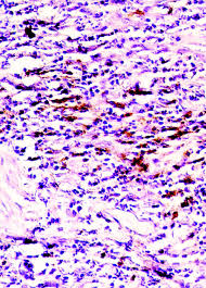 Below is a list of common medications used to treat or reduce the symptoms of severe recalcitrant nodular acne. Severe Nodular Acne B Lymphocytes Located In The Perifollicular Download Scientific Diagram