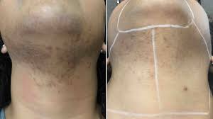 Pcos hair loss tip #1: Laser Hair Removal On Neck Chin For A Woman With Pcos Before And After Photos New Jersey