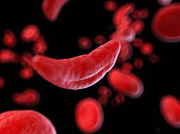 Sickle cell disease describes a group of inherited blood disorders characterized by chronic anemia, painful events, and various complications due to associated tissue and organ damage. New Medicines In The Pipeline To Treat Sickle Cell Disease 2020 09 18 Bioworld