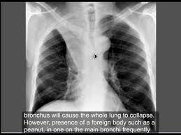 A small area of atelectasis, especially in an adult, usually is treatable. Respiratory System Chest Conditions Atelectasis Part 1 Youtube