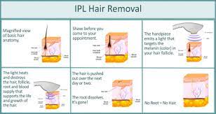 It heats up along the way, and by the time it gets to the follicle, that heat is enough to damage the follicle. Ipl Laser Hair Removal Glowry Cosmetic Clinic