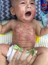 Cukup guna sabun untuk bayi. 5 Months Of Agony Severe Eczema Cerita Eczema Aryan