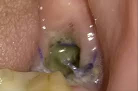 Image result for Alveolitis sicca)