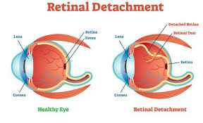 Circulatory causes of retinal detachment in cats high blood pressure (systemic hypertension) is the most common cause of retinal detachments in the cat. Retinal Detachment In Cats Cat World