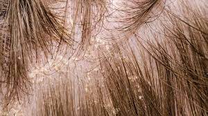 These conditions include eczema, rash, and allergies. Scalp Eczema Definition Treatment Prevalance Everyday Health
