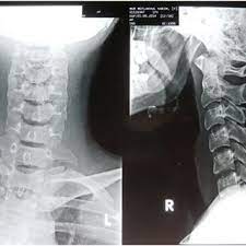 Please understand that our phone lines must be clear for urg. Ap And Lateral View Of Cervical Spine X Ray There Is No Fracture And Download Scientific Diagram