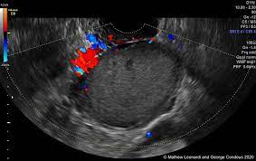 We did not find results for: Noninvasive Ultrasound Diagnosis Of Endometriosis