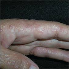 If your skin has broken out in a red itchy rash during your pregnancy, you could have aep. Itchy Rash On Sides Of Fingers Mdedge Family Medicine