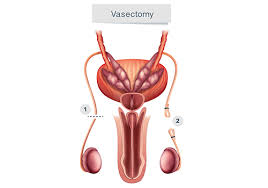 Image result for Vasectomy