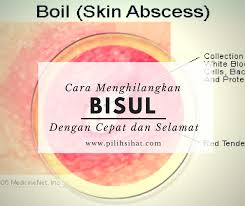 1,205 likes · 36 talking about this. Ubat Untuk Hilangkan Bisul Di Kemaluan Rawatan X