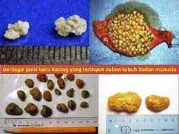 Penyakit batu ginjal perlu dikontrol agar tidak bertambah parah dan memicu komplikasi kesehatan. Penyakit Batu Karang In English