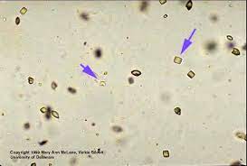 Oxalate And Uric Acid Crystals In Acidic Urine Medical Laboratories