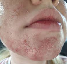 Jangkitan ini agak biasa dan untuk pelepasan sementara kulat kuku jari kaki, celupkan katun kapas pada minyak cengkih dan sapukan ke kuku dan kulit di sekelilingnya, menurut. Apa Tu Jerawat Kulat Fungal Acne Punca Rawatan Gejala Bluebell Skincare