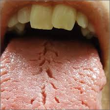 Image result for Fissured tongue