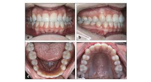 Image result for Dentition