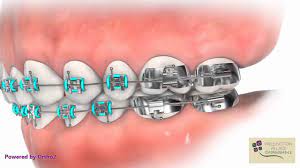 Azdent orthodontic wax for braces. Wax Placement And Pokey Wire Braces Wellington Village Orthodontics Youtube