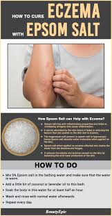 Epsom salt can be highly effective in curing your eczema efficiently. How To Use Epsom Salt For Eczema Psoriasis Remedies Psoriasis Cure Eczema Remedies