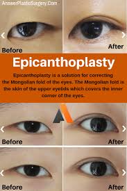 What Is Epicanthoplasty Details Of The Procedure Operation Process Before After Epicanthic Fold Upper Eyelid Double Eyelid