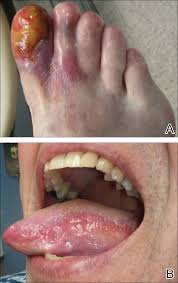 Image result for lichen planus on tongue)