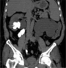 6 фраз в 3 тематиках. Msct Renal Stone Protocol Dose Penalty And Influence On Management Decision Of Patients Is It Really Worth The Radiation Dose Sciencedirect